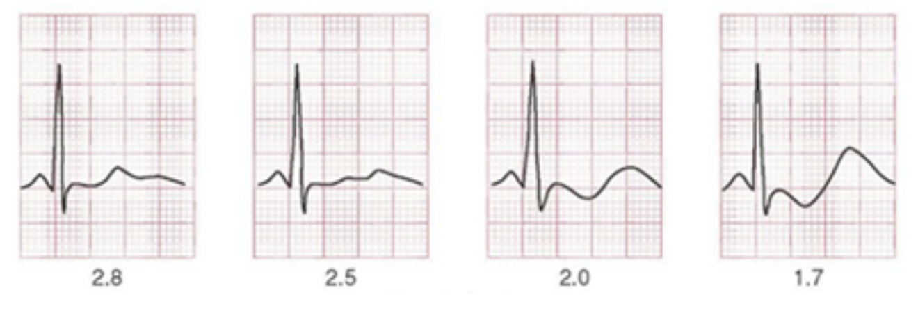 Hypokalaemia Hypokalaemia
